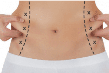 Care sunt beneficiile liposuctiei?