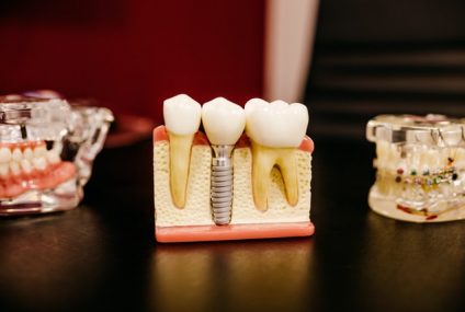 Cum decurge tratamentul cu implant dentar pentru restaurarea danturii?